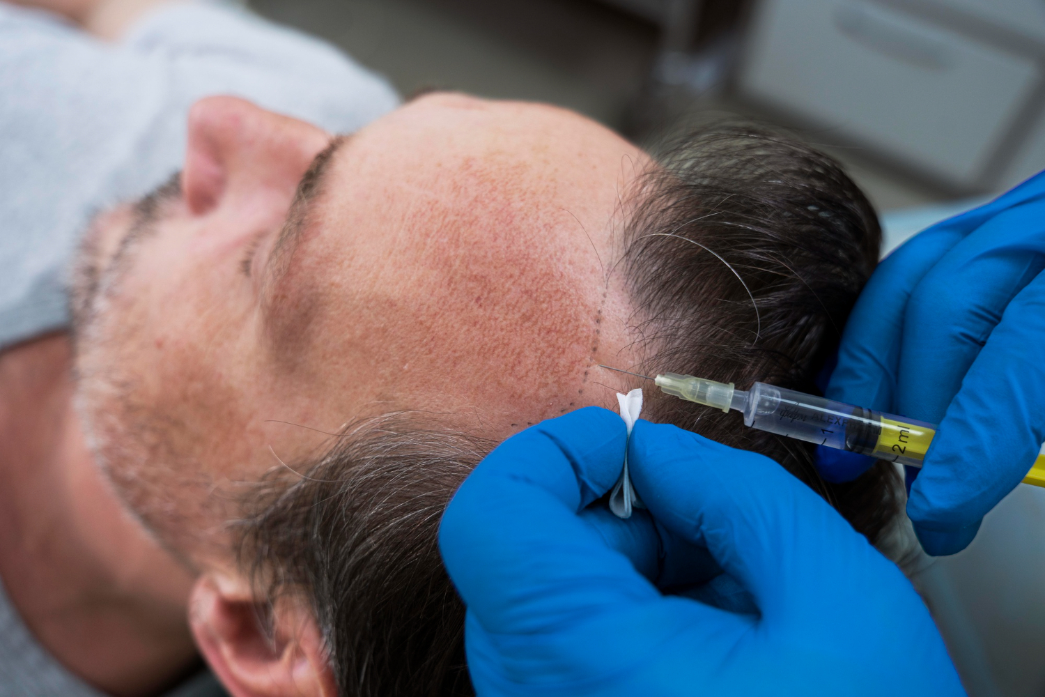 man-getting-hair-loss-treatment-prp-dermatology